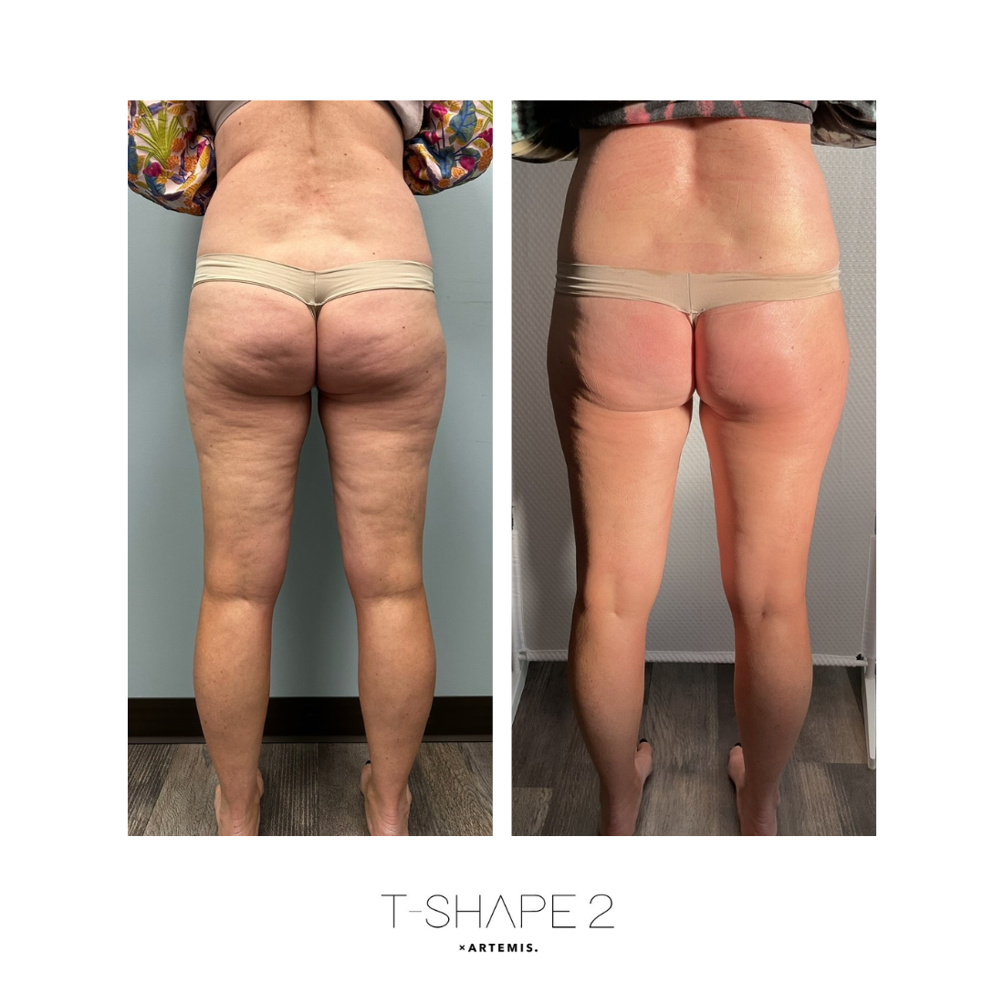 Before and after of a womanwith lots of cellulite and then smooth skin who has had T-Shape 2
