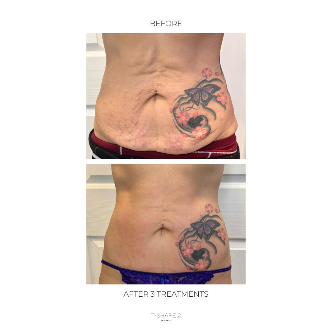 A before and after photo of a woman 's stomach with tattoos.