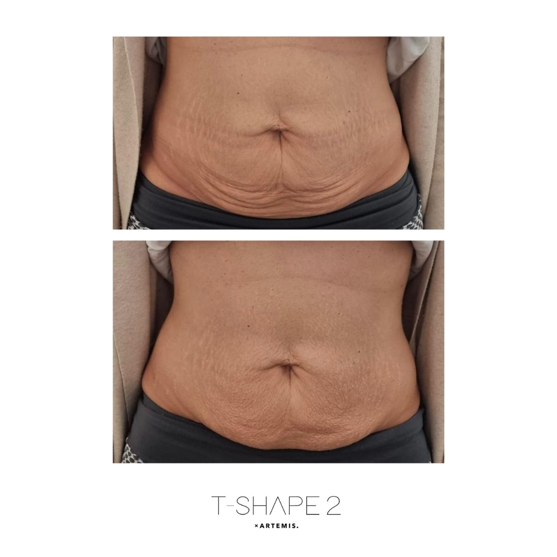 A before and after photo of a woman 's stomach