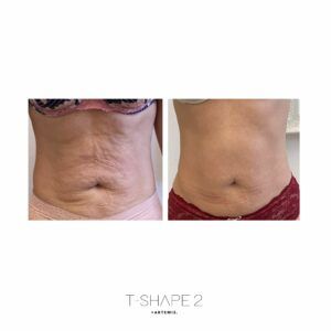 A before and after picture of a woman's stomach looking more toned after Tshape 2 treatment