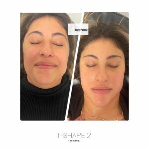 A before and after photo of a woman who had T-Shape 2 on her face with her eyes closed.