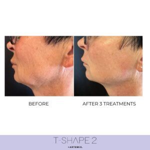 A before-and-after photo of a woman's jaw and neck skin looking tighter and firmer.