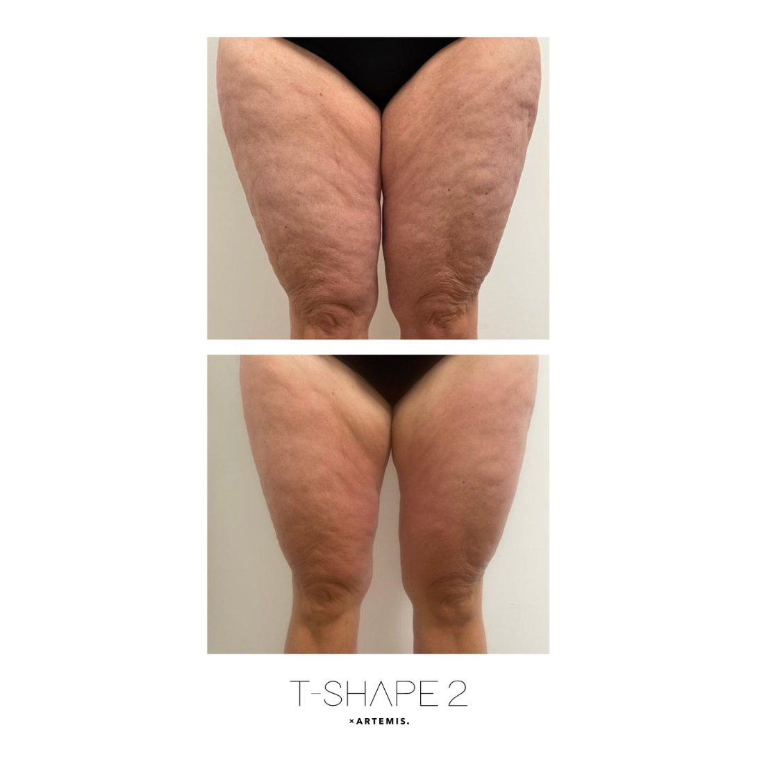A womans thighs before and after a T-Shape 2 treatment