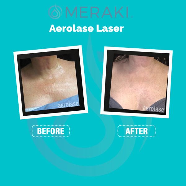 meraki aerolase treatment example chest or breast area