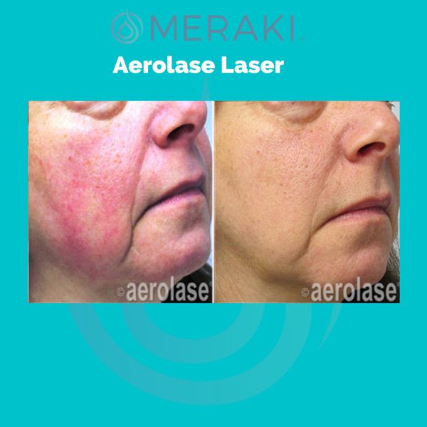 meraki aerolase treatment example face