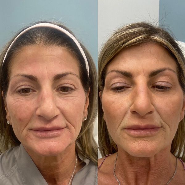 A before and after photo of a woman 's face.