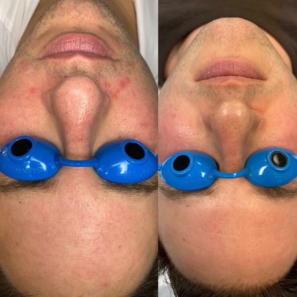A before and after photo of a man wearing blue goggles.