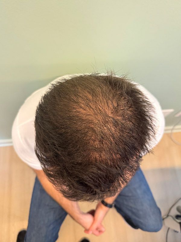 Top-down view of a person’s head showing hair thinning and scalp visibility on the crown.