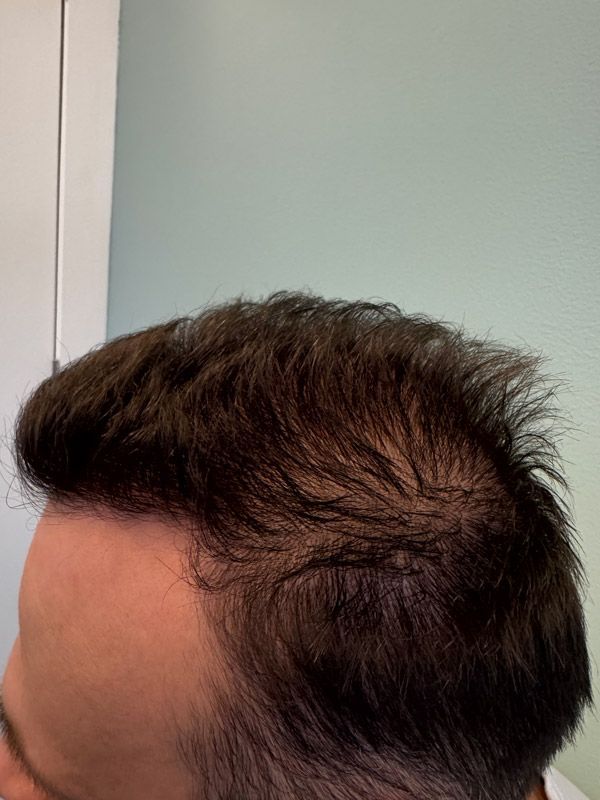 Side profile view of a person’s dark brown hair showing signs of thinning at the crown and receding at the temple.