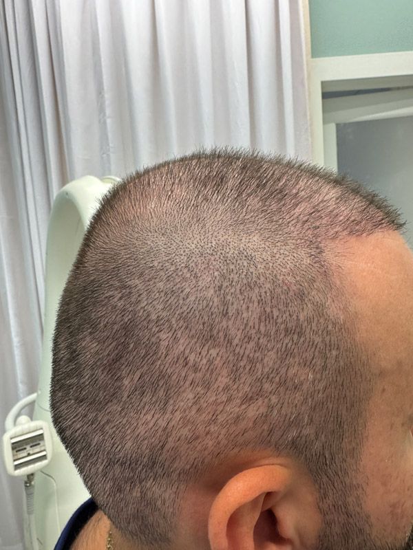 Side profile of a person's shaved head showing stubble, likely shortly after a hair transplant procedure.