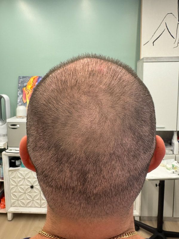 A person seen from behind, showing the freshly shaved back of the head and donor area after a hair transplant procedure.