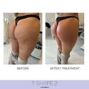 Womns glutes before and after T-Shape 2 with less cellulite