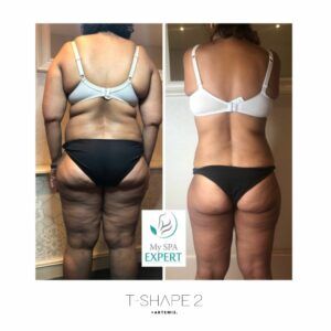 A before and after picture of a woman before and after T-Shape 2.