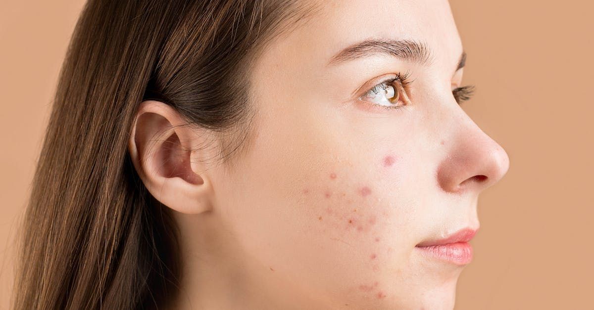 A close up of a woman 's face with acne on it.