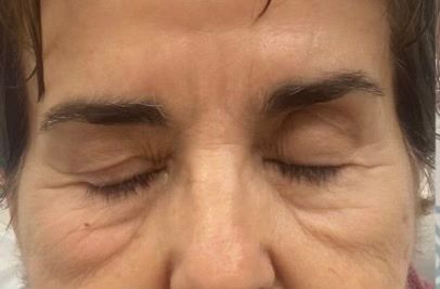 rf microneedling before and after gallery at meraki new york and mobile