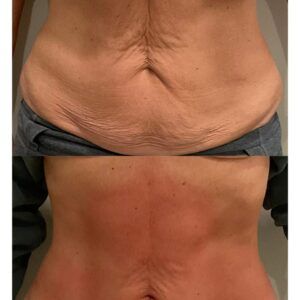 A before and after picture of a woman 's stomach with less sagging skin using T-Shape 2.