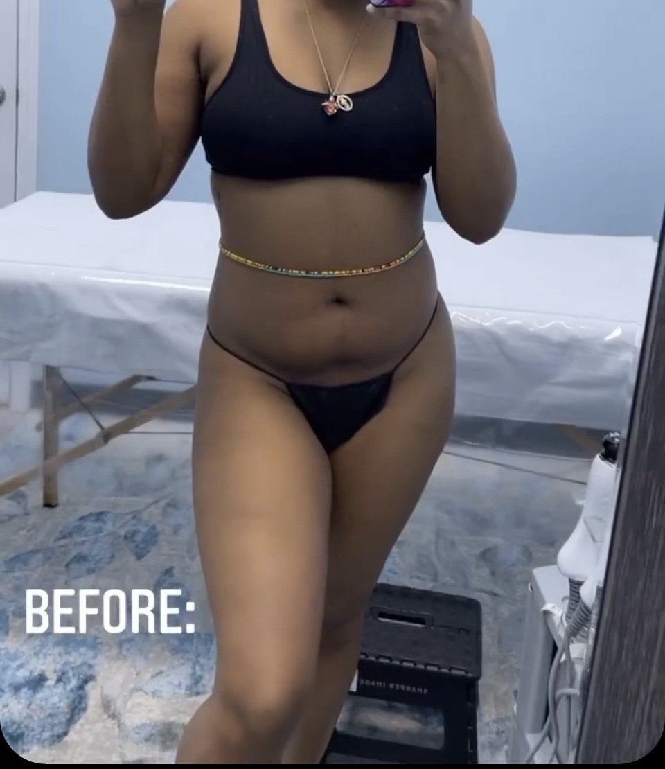 Body Contouring Before Second Treatment — Stockbridge, GA — Body Glow Wax