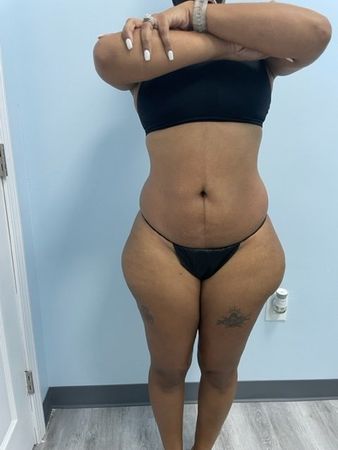 Body Contouring Stomach After — Stockbridge, GA — Body Glow Wax