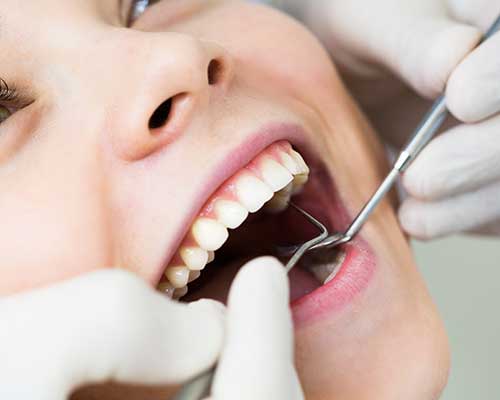 donne con la bocca aperta durante orale checkup