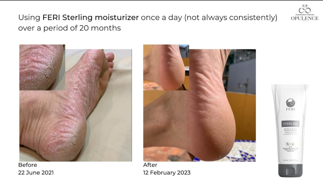 Foot testimonial for the FERI Sterling Hand & Body Moisturizer