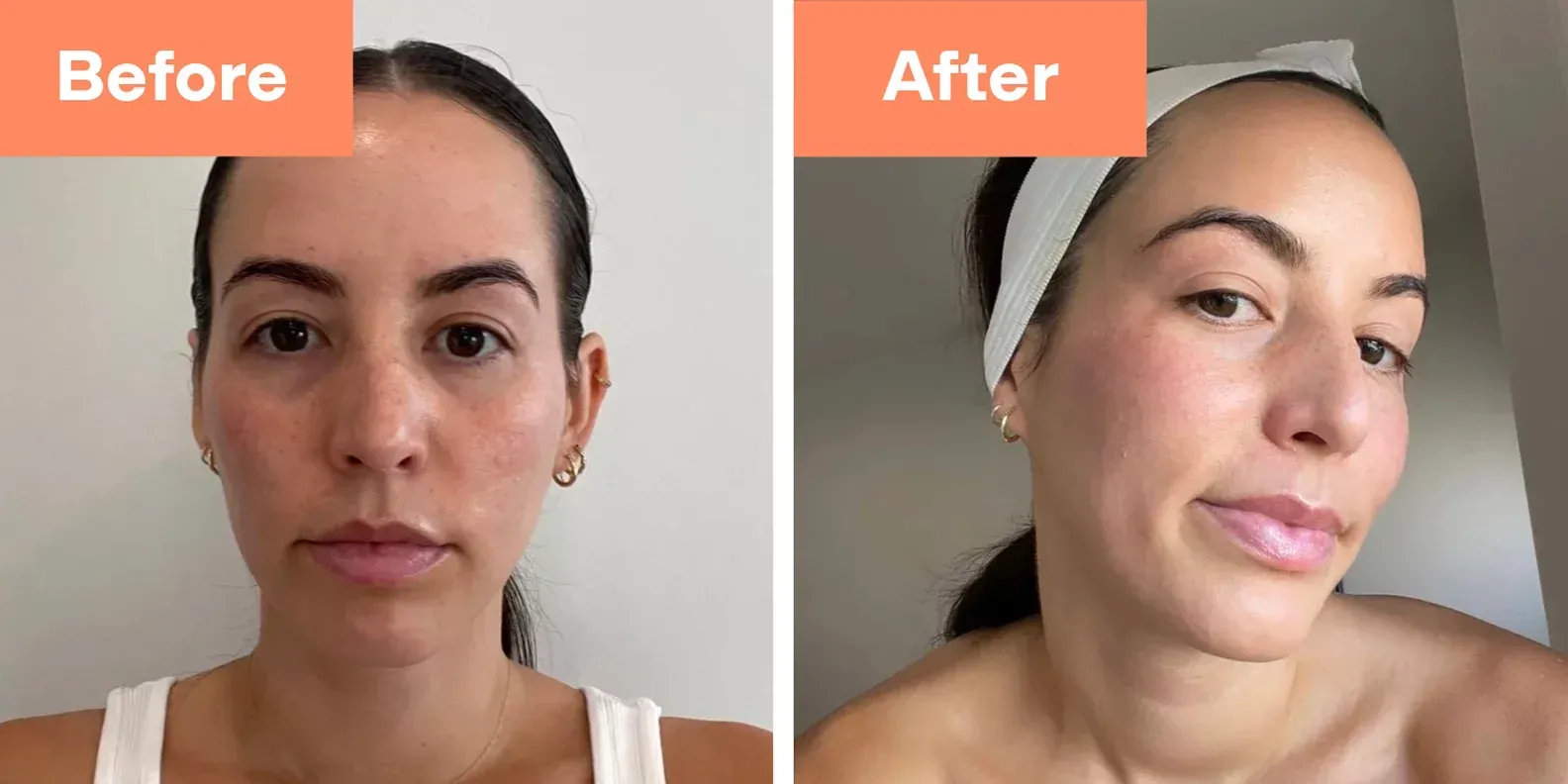 before and after results of a diamondglow facial treatment