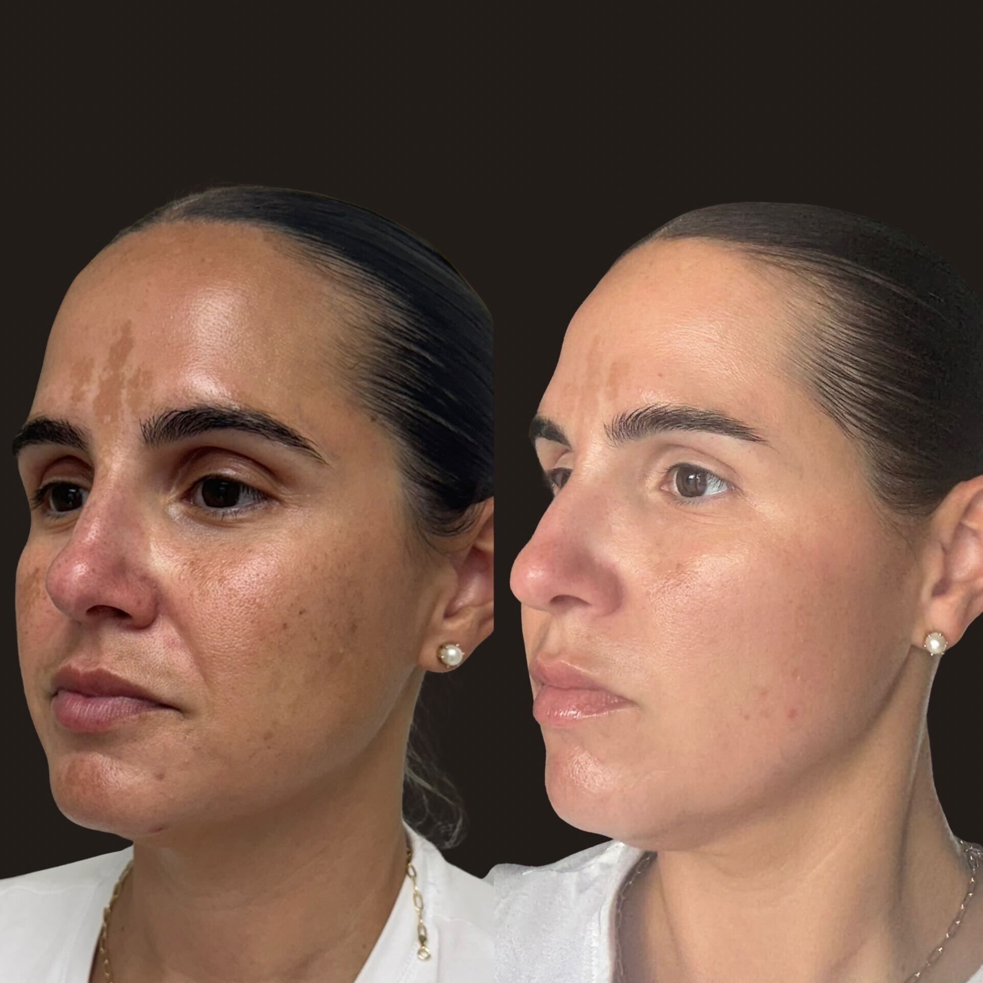 HALO laser before and after acne scar treatment results