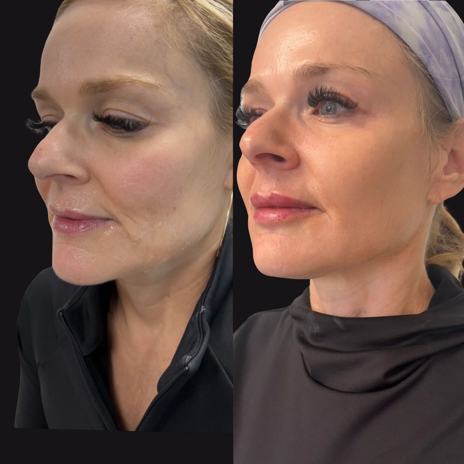 sculptra treatment before and after results