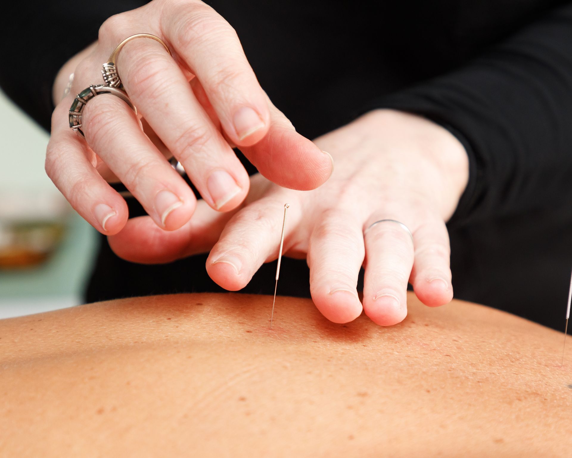 Hands inserting acupuncture needles into a person's back.