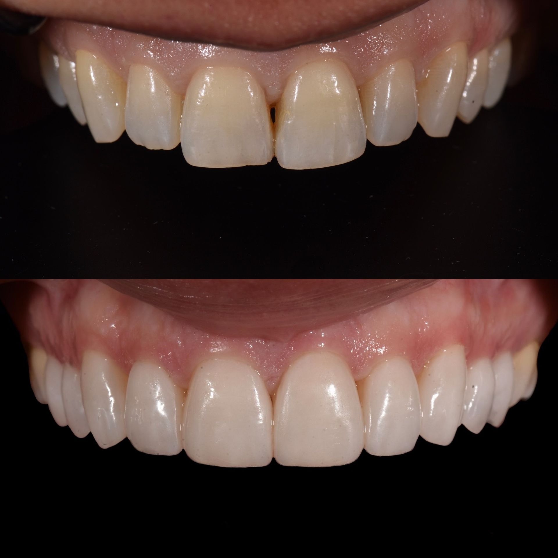 How much do porcelain veneers cost in Melbourne?