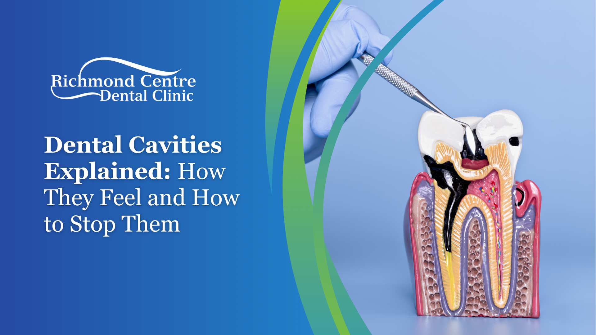 Dental model showing cavity, a gloved hand with dental tools, blue and green accents, with text.