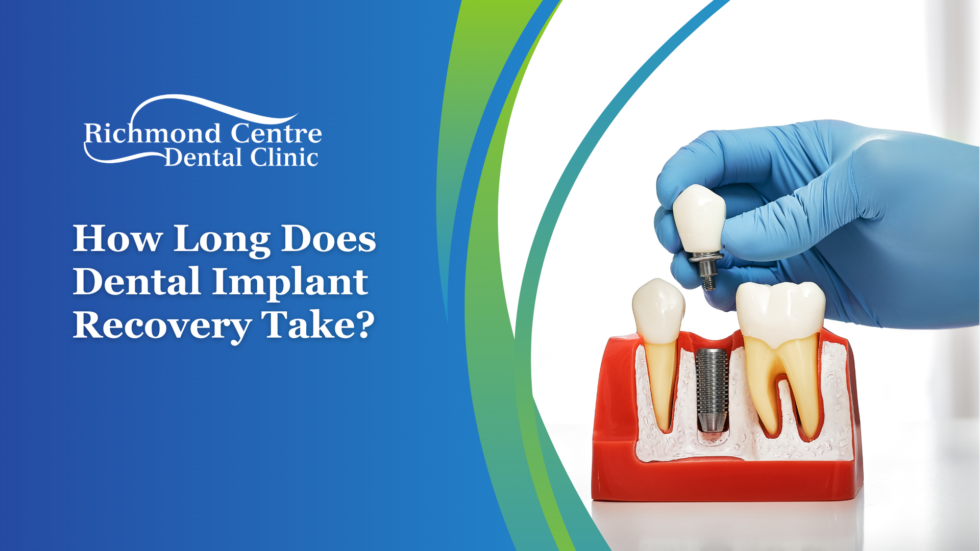 Dental implant model and dental clinic logo, text: How Long Does Dental Implant Recovery Take?