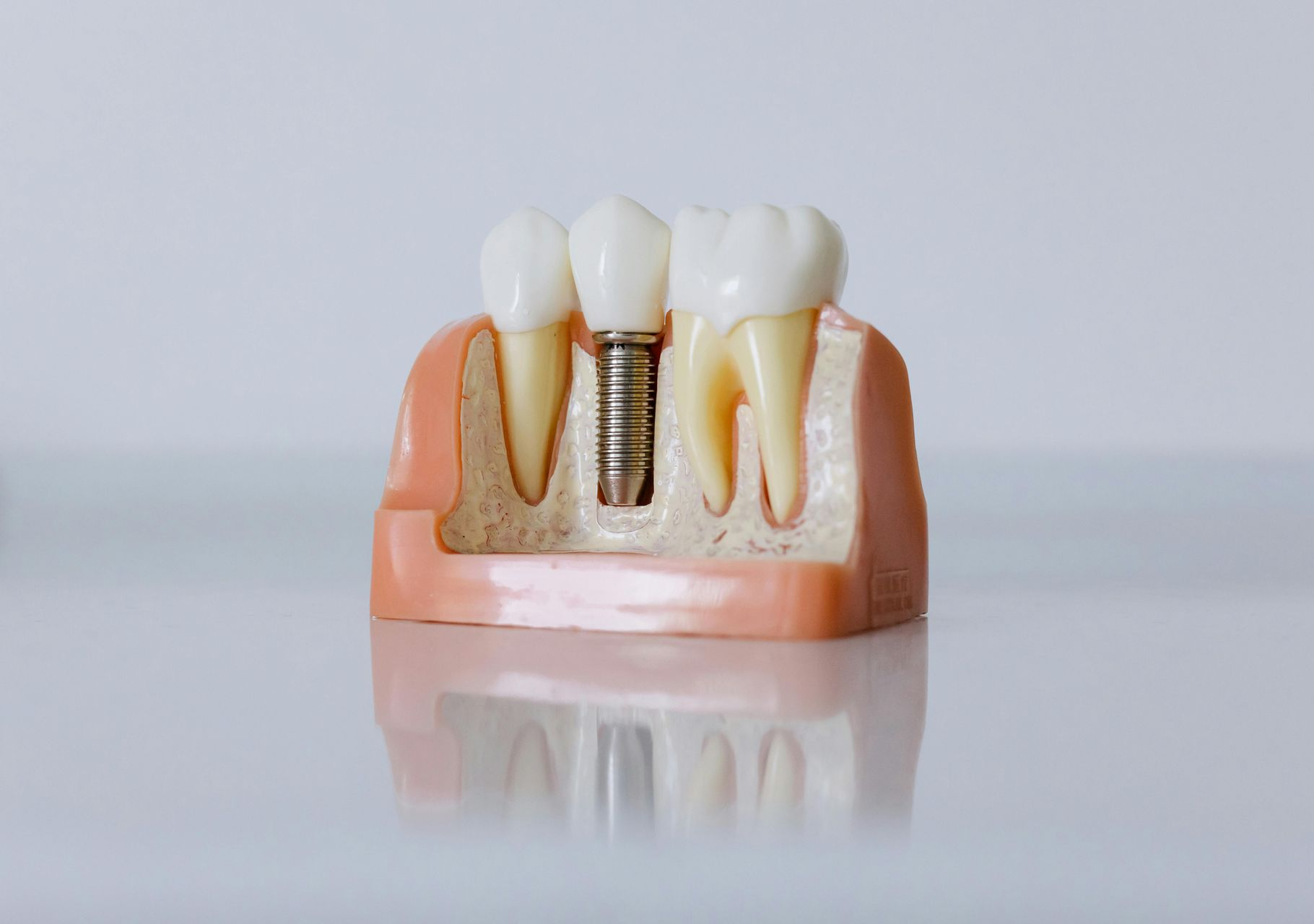 Dental model showing a tooth implant between two natural teeth, in a pink gum and white background.