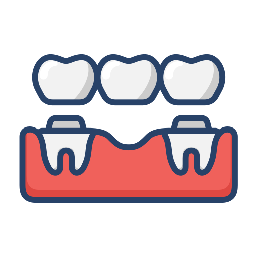 dental veneer