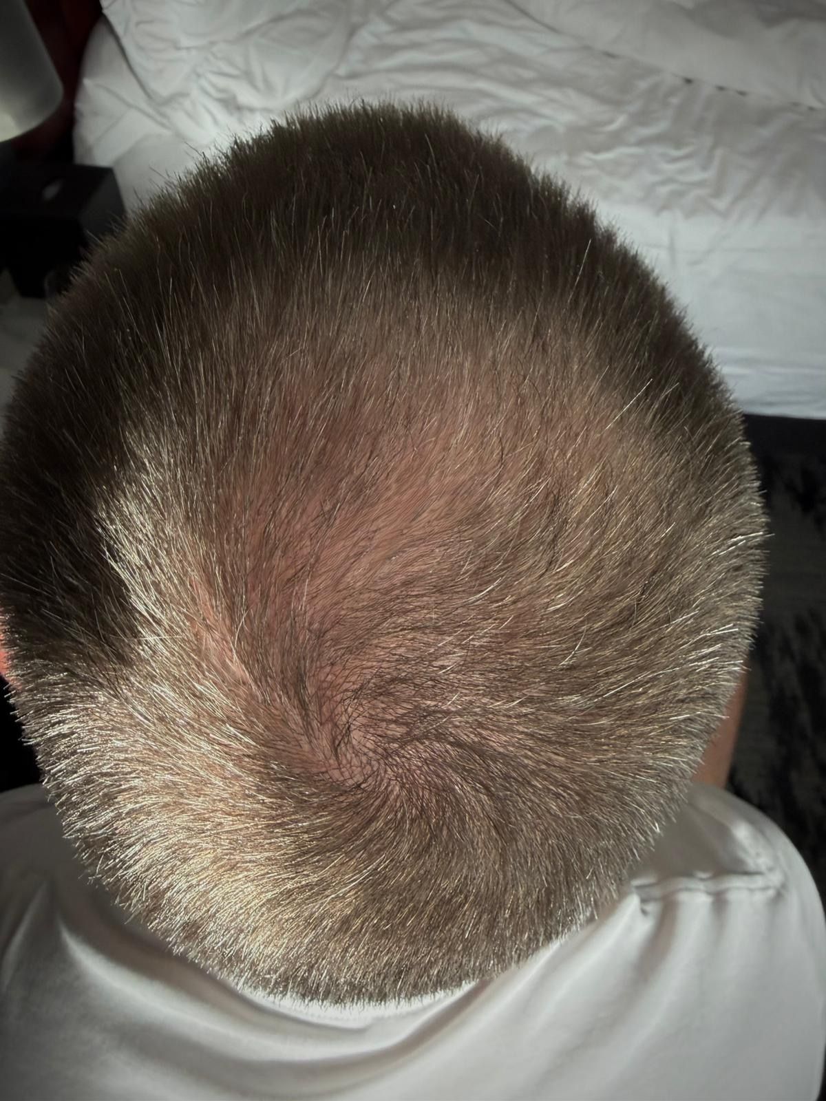 Profil eines Mannes mit dünner werdendem Haar vor und nach einmahme vom Cove Protect