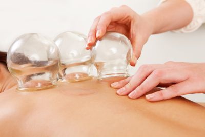 Image of cupping therapy being performed at acupuncture clinic.
