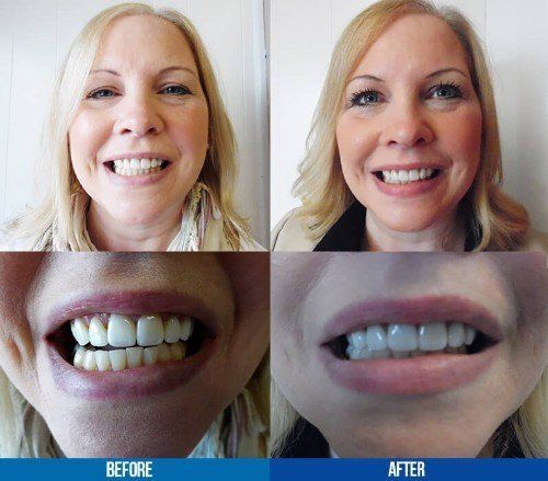 before and after photos of female patient from Eastwood Dental Office in Syracuse New York