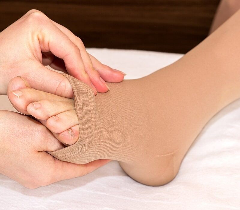 Person Putting on a Compression Stocking on a Foot — Ballina Home Healthcare Sales & Hire and Compression Stockings Plus in Ballina, NSW