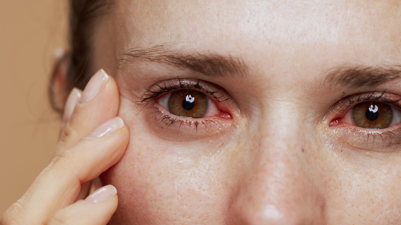 eye allergy treatment