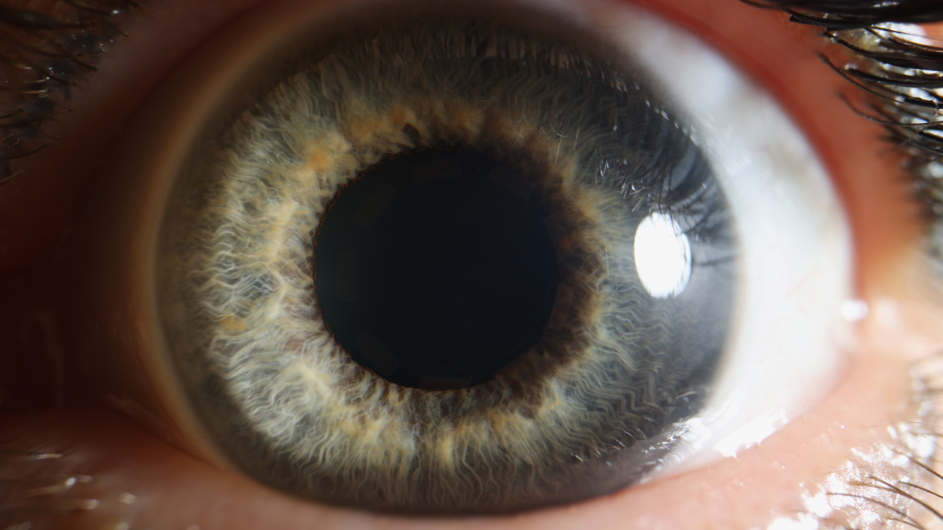 dilated eye exam