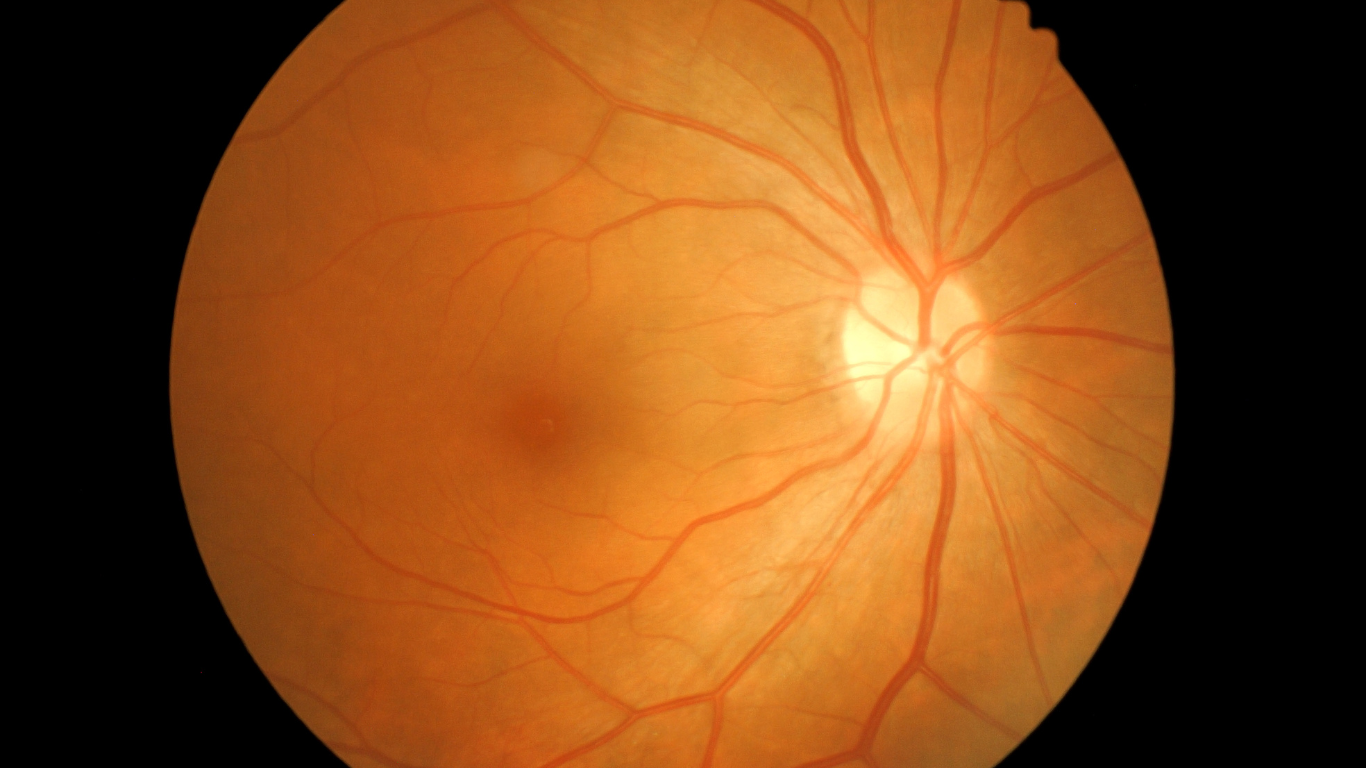 retinal imaging