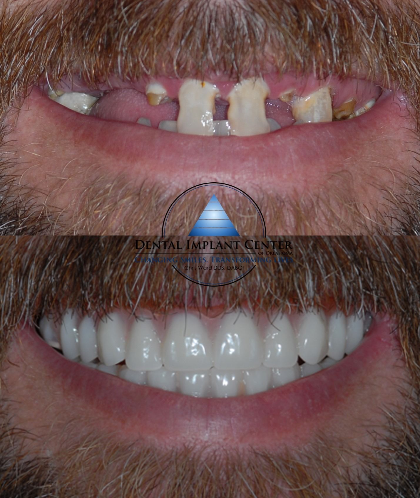 Dental Implant Center of Oklahoma - Before and After