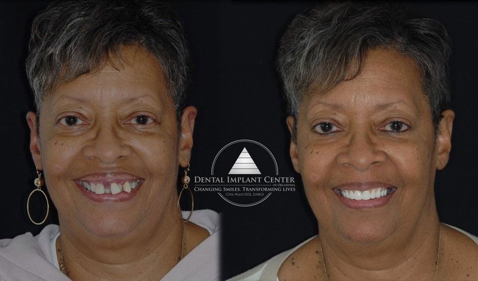 Dental Implant Center of Oklahoma - Before and After