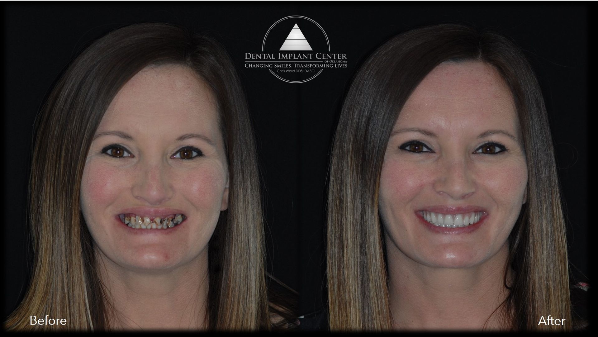 Dental Implant Center of Oklahoma - Before and After
