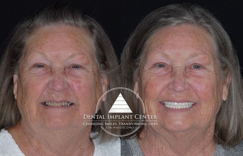 Dental Implant Center of Oklahoma - Before and After