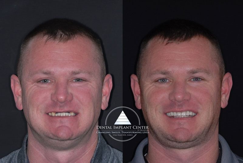 Dental Implant Center of Oklahoma - Before and After