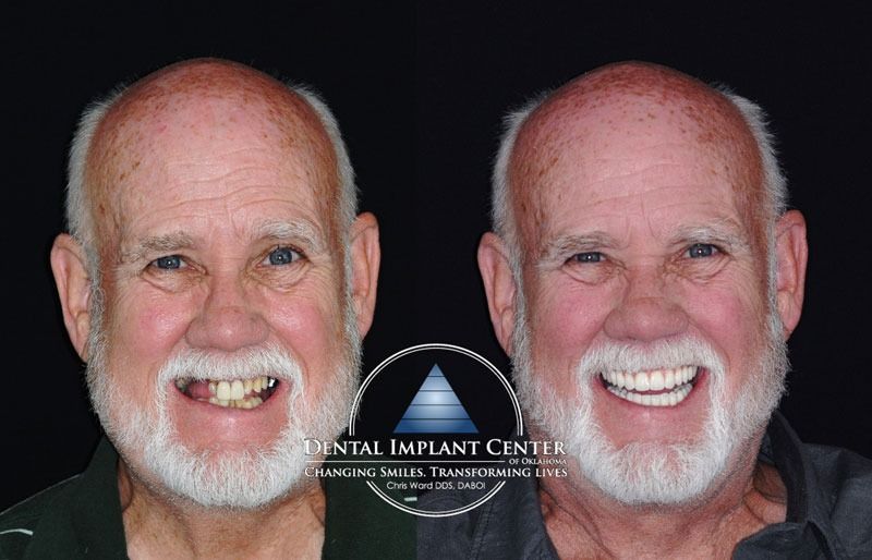 Dental Implant Center of Oklahoma - Before and After