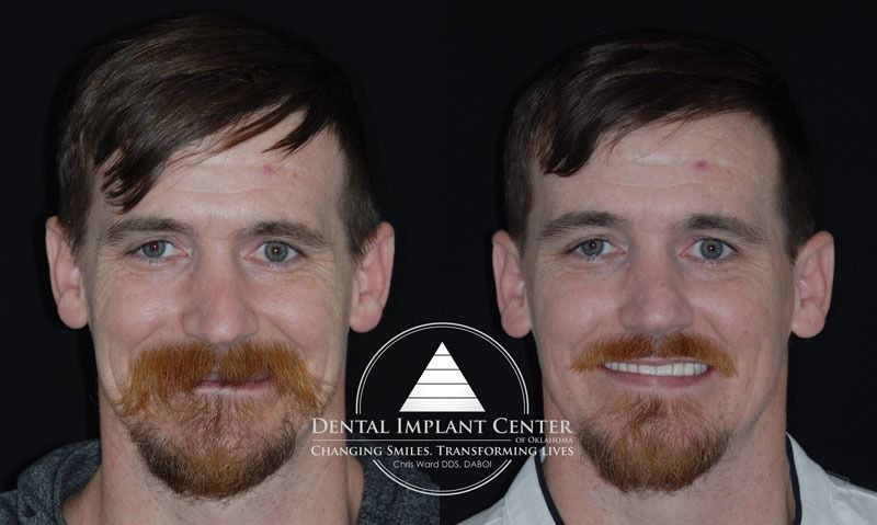 Dental Implant Center of Oklahoma - Before and After