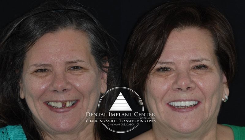 Dental Implant Center of Oklahoma - Before and After