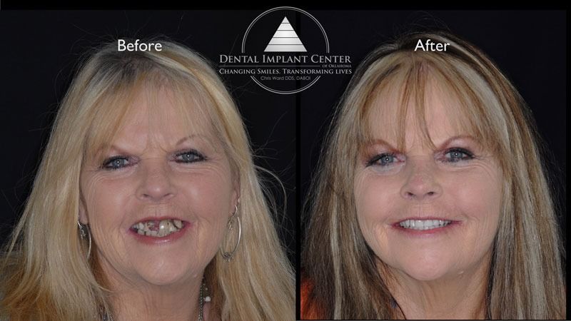 Dental Implant Center of Oklahoma - Before and After