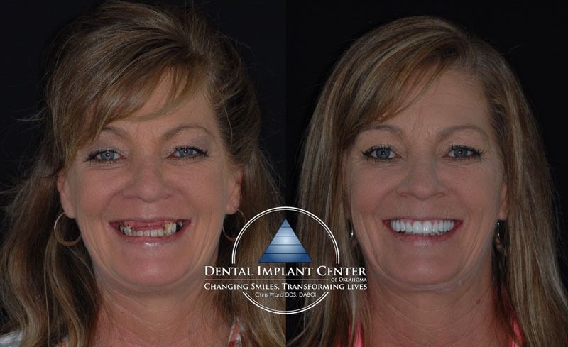 Dental Implant Center of Oklahoma - Before and After